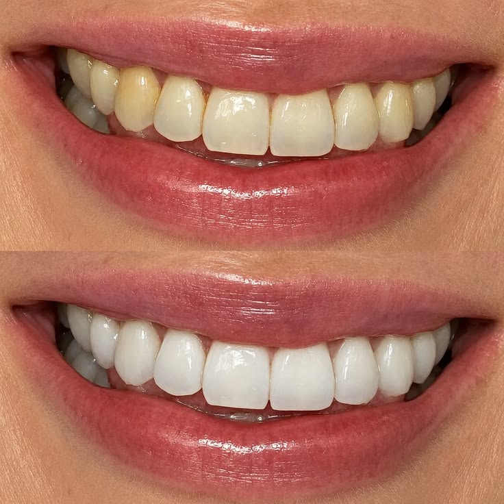 SaySmile Whitening Strips