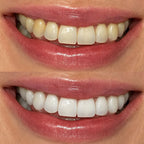 SaySmile Whitening Strips